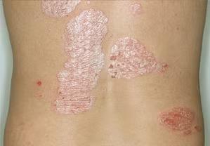 Psoriasis