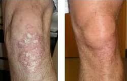 Före - Efter Psoriasis, Före - Efter