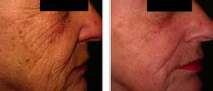 Före - Efter Skin Rejuvenation, Före - Efter