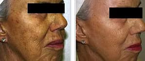 Före - Efter Skin Rejuvenation, Före - Efter