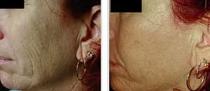 Före - Efter Skin Rejuvenation, Före - Efter