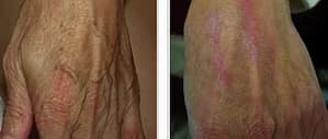 Före - Efter Skin Rejuvenation, Före - Efter