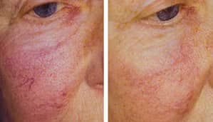 Före - Efter Ytliga blodkärl, Före - Efter